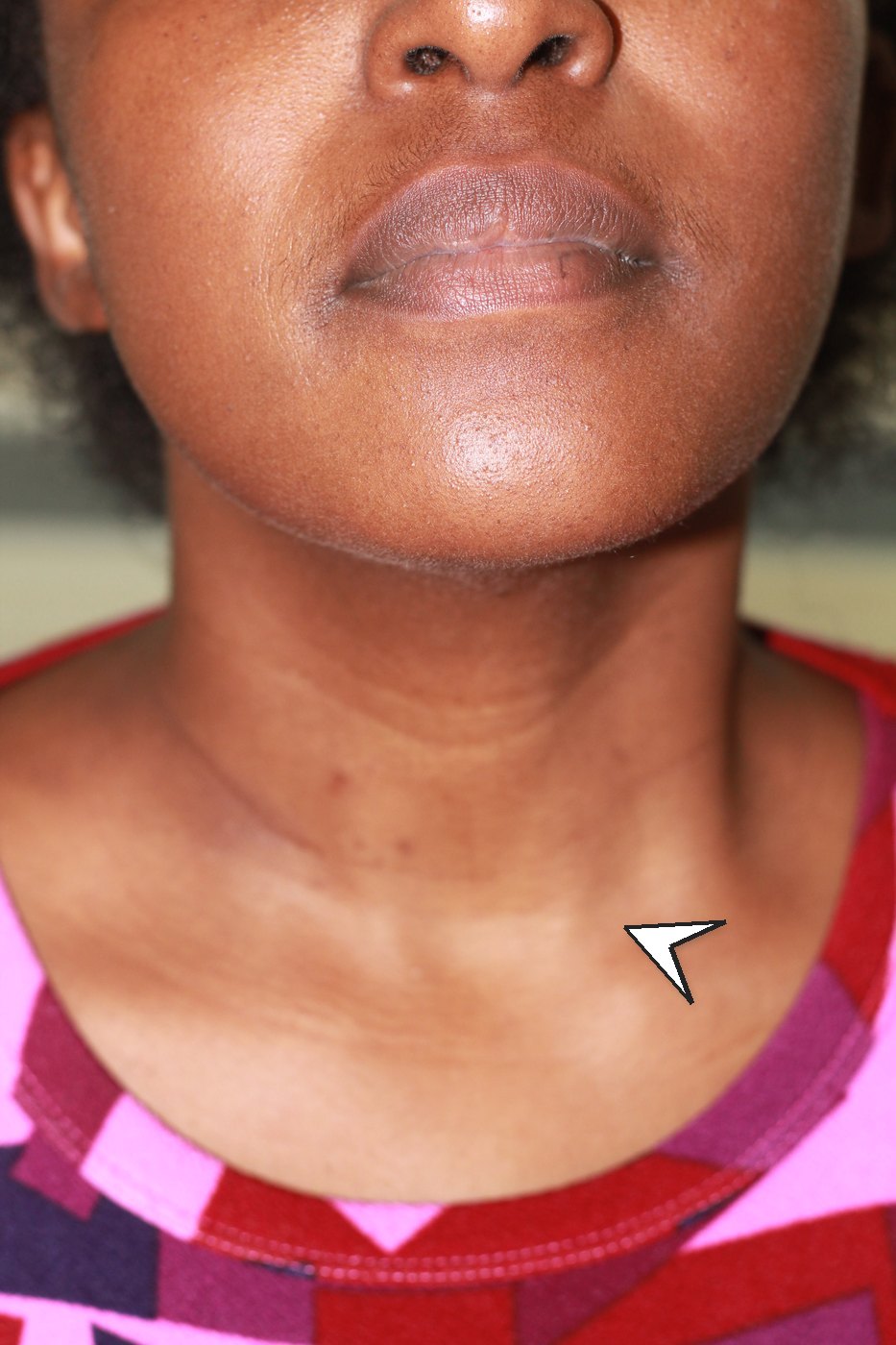 One month after RFA — the neck swelling resolved (anonymised; shared with written consent)