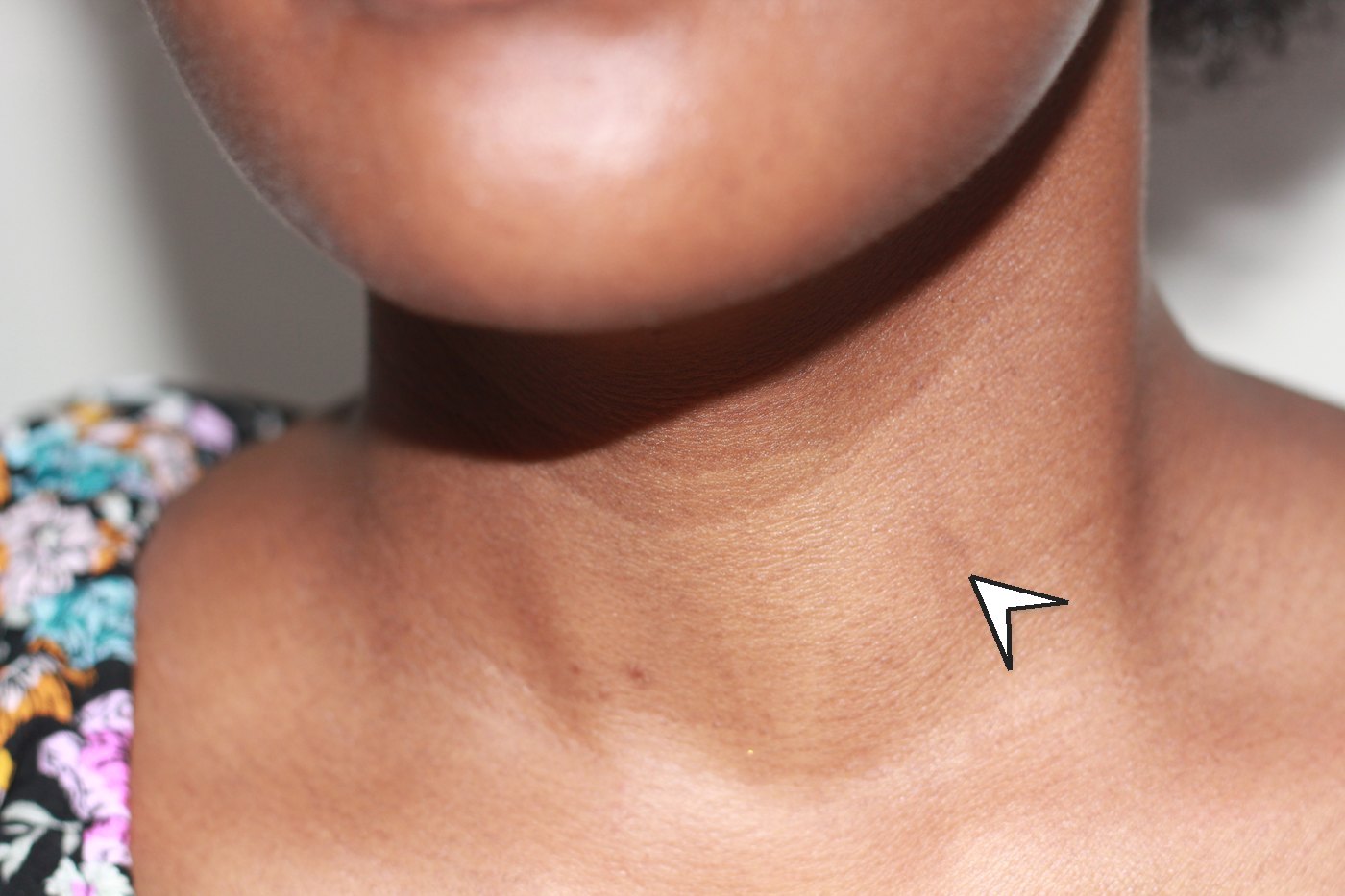 Before RFA — a visible swelling from a large benign thyroid nodule (anonymised; shared with written consent)