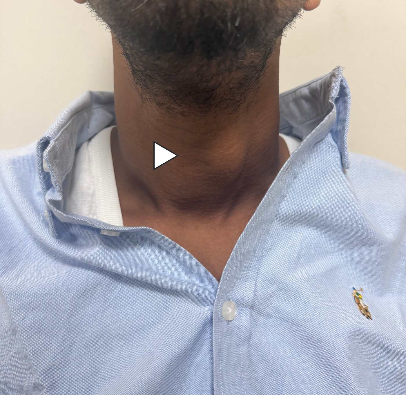 Before RFA — a visible goitre swelling at the front of the neck (anonymised; shared with written consent)